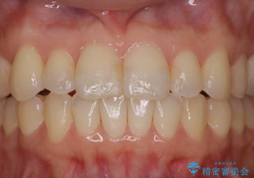 矯正治療とセラミック治療が終了後のPMTCの治療前
