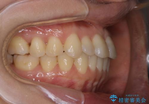 矯正治療とセラミック治療が終了後のPMTCの治療前