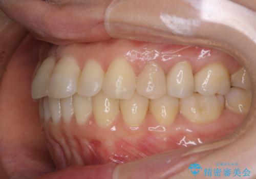 矯正治療とセラミック治療が終了後のPMTCの治療前