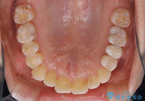 矯正治療とセラミック治療が終了後のPMTCの治療前