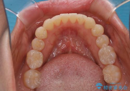 矯正治療とセラミック治療が終了後のPMTCの治療前