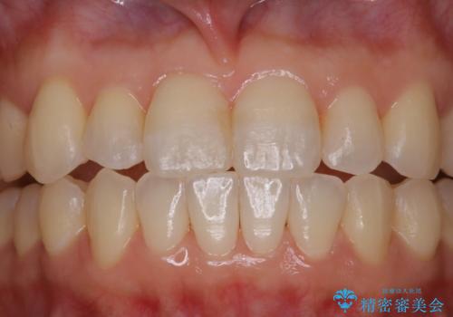 矯正治療とセラミック治療が終了後のPMTCの治療後