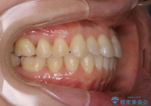 矯正治療とセラミック治療が終了後のPMTCの治療後