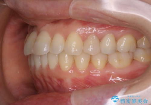 矯正治療とセラミック治療が終了後のPMTCの治療後