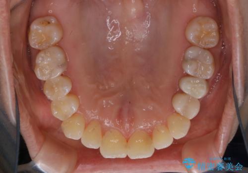 矯正治療とセラミック治療が終了後のPMTCの治療後