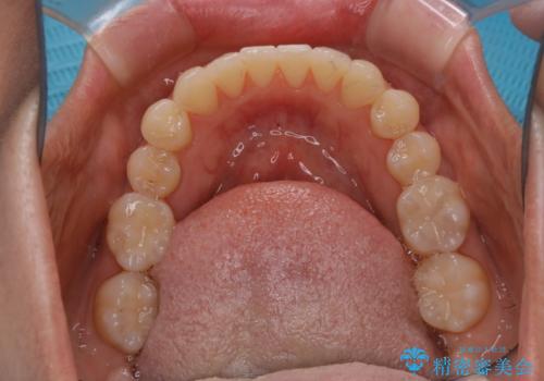 矯正治療とセラミック治療が終了後のPMTCの治療後