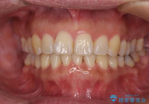 軽度な歯列不正　インビザライン・ライトによる矯正治療