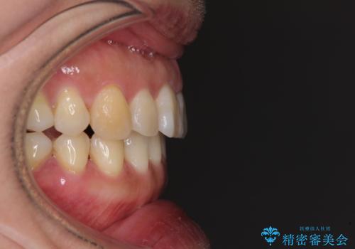 軽度な歯列不正　インビザライン・ライトによる矯正治療の治療後