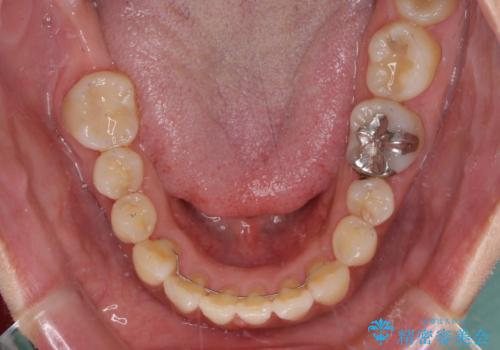 軽度な歯列不正　インビザライン・ライトによる矯正治療の治療後
