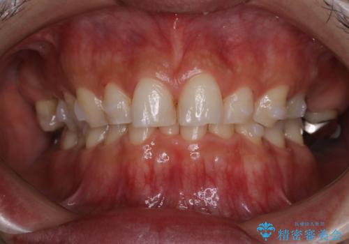 インビザラインでのマウスピース矯正中にPMTCでステインの除去の治療前