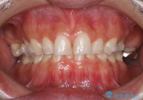 インビザラインでのマウスピース矯正中にPMTCでステインの除去の治療後