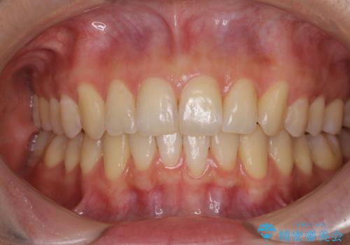 インビザラインによる矯正治療　カリエールディスタライザーを用いた奥歯の咬み合わせ改善の治療後