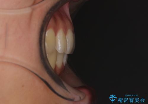 インビザラインによる矯正治療 カリエールディスタライザーを用いた奥歯の咬み合わせ改善の治療後