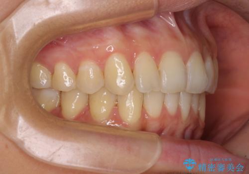 インビザラインによる矯正治療 カリエールディスタライザーを用いた奥歯の咬み合わせ改善の治療後