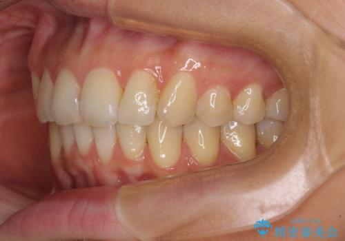 インビザラインによる矯正治療 カリエールディスタライザーを用いた奥歯の咬み合わせ改善の治療後