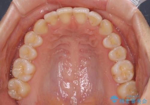 インビザラインによる矯正治療　カリエールディスタライザーを用いた奥歯の咬み合わせ改善の治療後