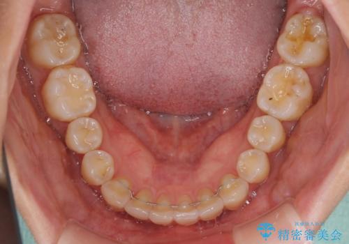 インビザラインによる矯正治療 カリエールディスタライザーを用いた奥歯の咬み合わせ改善の治療後