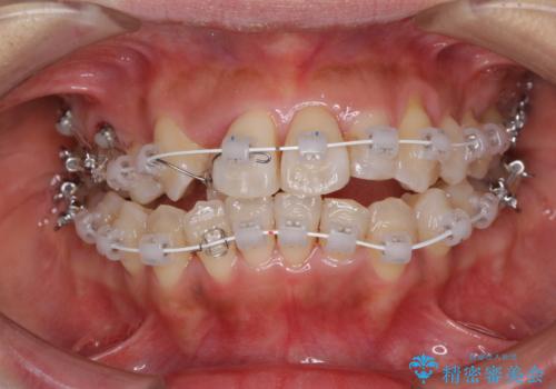 狭い上顎骨を拡大 著しい叢生を抜歯矯正で改善の治療中