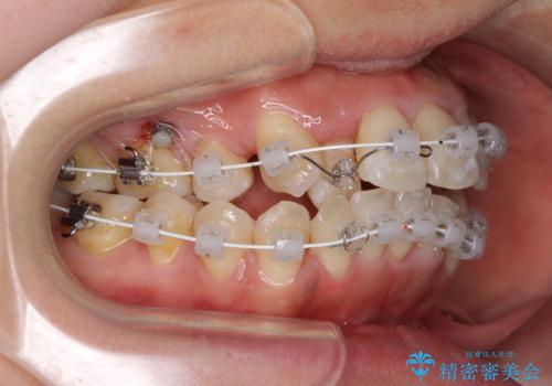 狭い上顎骨を拡大 著しい叢生を抜歯矯正で改善の治療中