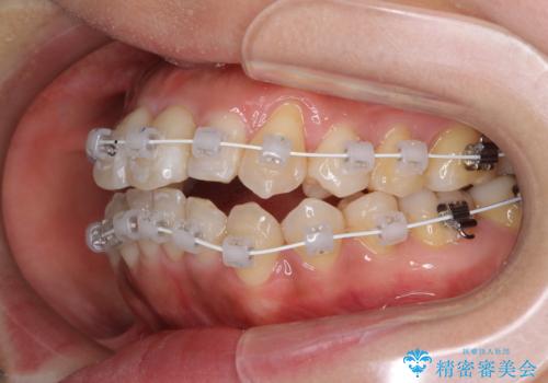狭い上顎骨を拡大 著しい叢生を抜歯矯正で改善の治療中