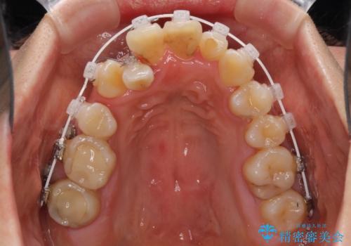 狭い上顎骨を拡大 著しい叢生を抜歯矯正で改善の治療中