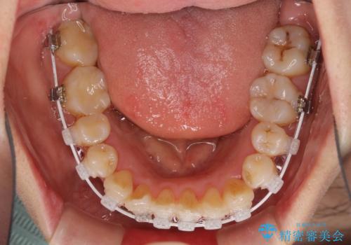 狭い上顎骨を拡大　著しい叢生を抜歯矯正で改善の治療中