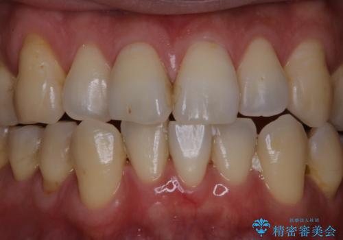 歯医者に久しぶりの来院でPMTC60分コースの治療前
