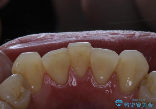 歯医者に久しぶりの来院でPMTC60分コースの治療前