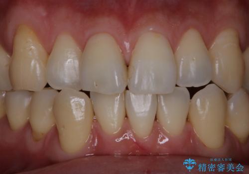 歯医者に久しぶりの来院でPMTC60分コースの治療後