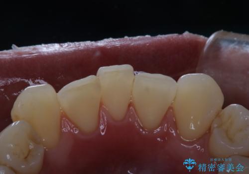 歯医者に久しぶりの来院でPMTC60分コースの治療後