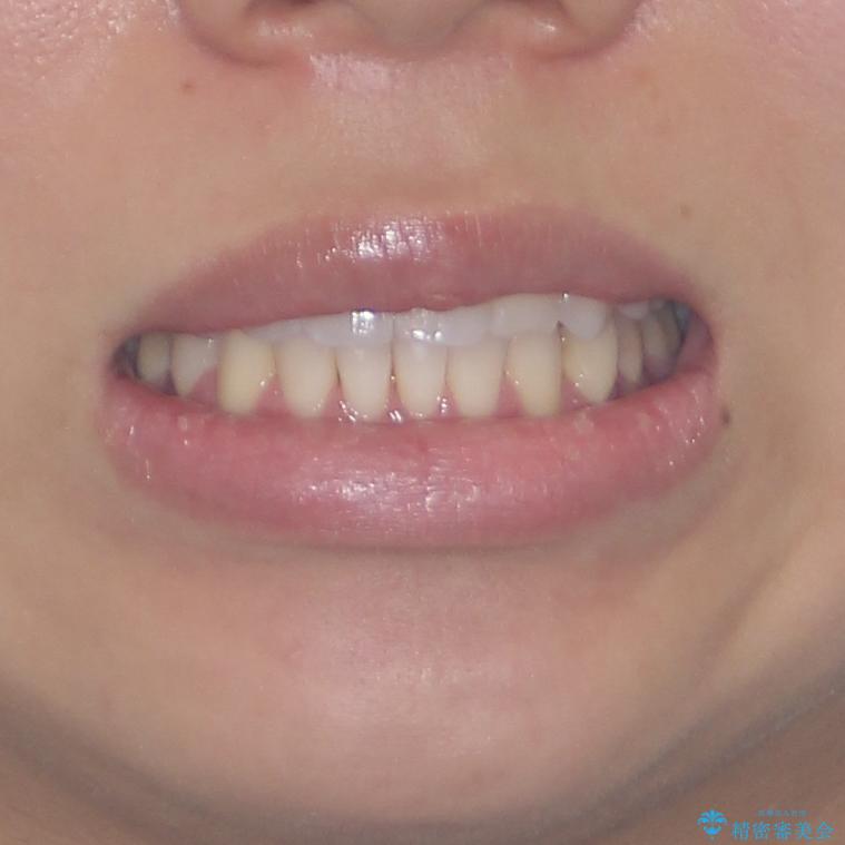 八重歯と奥歯のクロスバイト　上顎骨を拡大してインビザラインで矯正の治療後（顔貌）