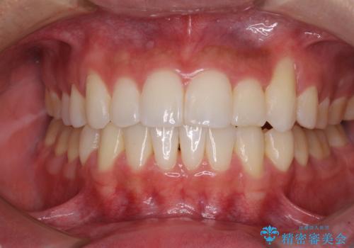 八重歯と奥歯のクロスバイト　上顎骨を拡大してインビザラインで矯正の治療後