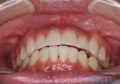 八重歯と奥歯のクロスバイト 上顎骨を拡大してインビザラインで矯正の治療後