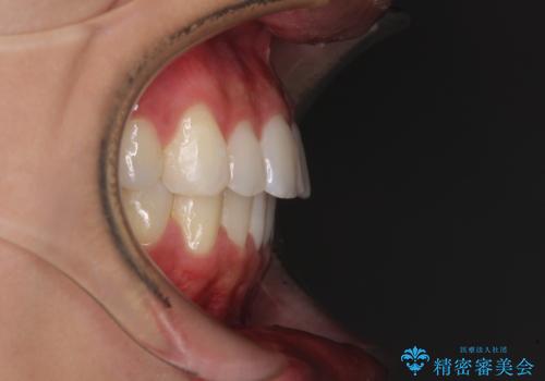 八重歯と奥歯のクロスバイト 上顎骨を拡大してインビザラインで矯正の治療後