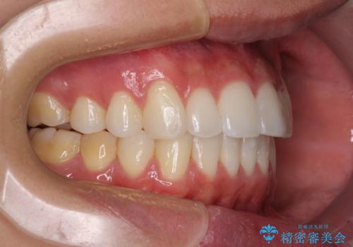 八重歯と奥歯のクロスバイト 上顎骨を拡大してインビザラインで矯正の治療後