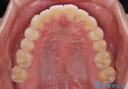 八重歯と奥歯のクロスバイト 上顎骨を拡大してインビザラインで矯正の治療後
