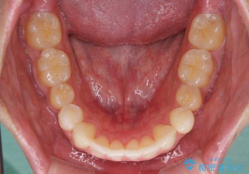 八重歯と奥歯のクロスバイト 上顎骨を拡大してインビザラインで矯正の治療後
