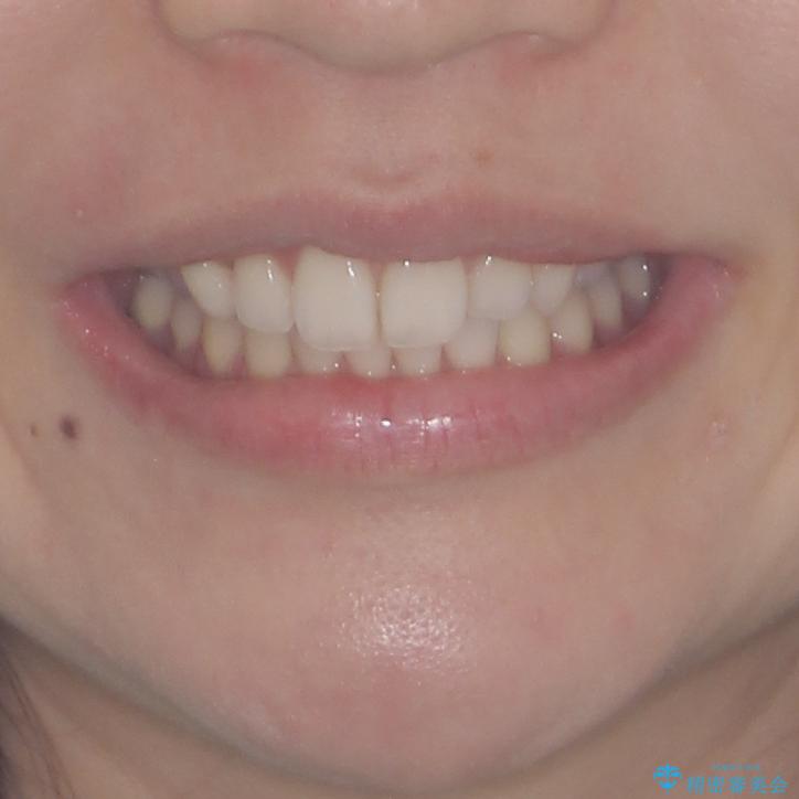 狭い上顎骨を拡大 急速拡大装置を併用したインビザライン矯正の治療後(顔貌)