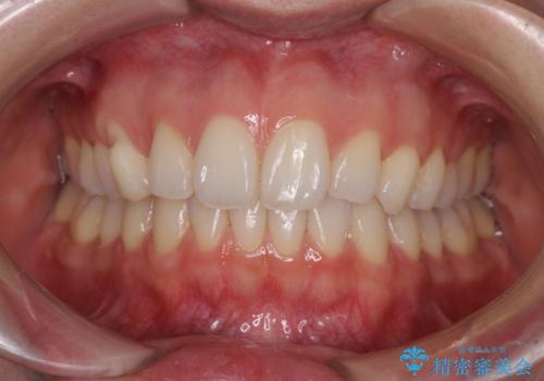 狭い上顎骨を拡大 急速拡大装置を併用したインビザライン矯正の症例 治療後