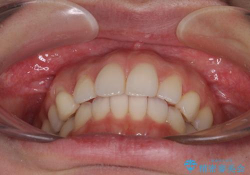 狭い上顎骨を拡大 急速拡大装置を併用したインビザライン矯正の治療後