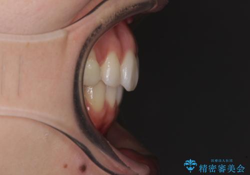 狭い上顎骨を拡大 急速拡大装置を併用したインビザライン矯正の治療後