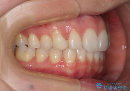 狭い上顎骨を拡大 急速拡大装置を併用したインビザライン矯正の治療後