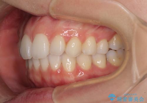 狭い上顎骨を拡大 急速拡大装置を併用したインビザライン矯正の治療後