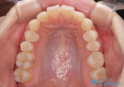 狭い上顎骨を拡大 急速拡大装置を併用したインビザライン矯正の治療後