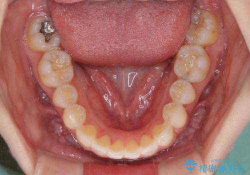 狭い上顎骨を拡大 急速拡大装置を併用したインビザライン矯正の治療後