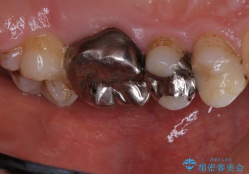 虫歯の治療を始める前にPMTCできれいにの症例 治療前