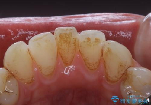 虫歯の治療を始める前にPMTCできれいにの治療前