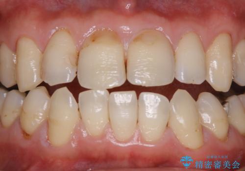 虫歯の治療を始める前にPMTCできれいにの治療後