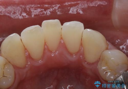 虫歯の治療を始める前にPMTCできれいにの治療後