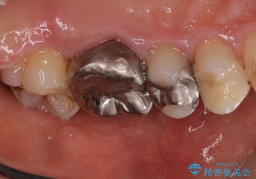 虫歯の治療を始める前にPMTCできれいにの症例 治療後